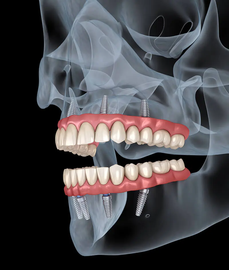 all-on-4 dental implants Huntington Beach, CA