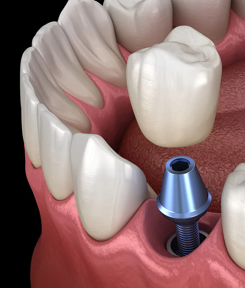 dental implants Huntington Beach, CA