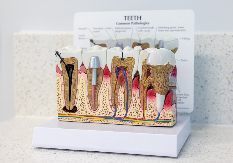 3D model showing periodontal diseases