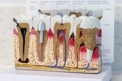 gallery_9_dentist_huntington_beach_ca