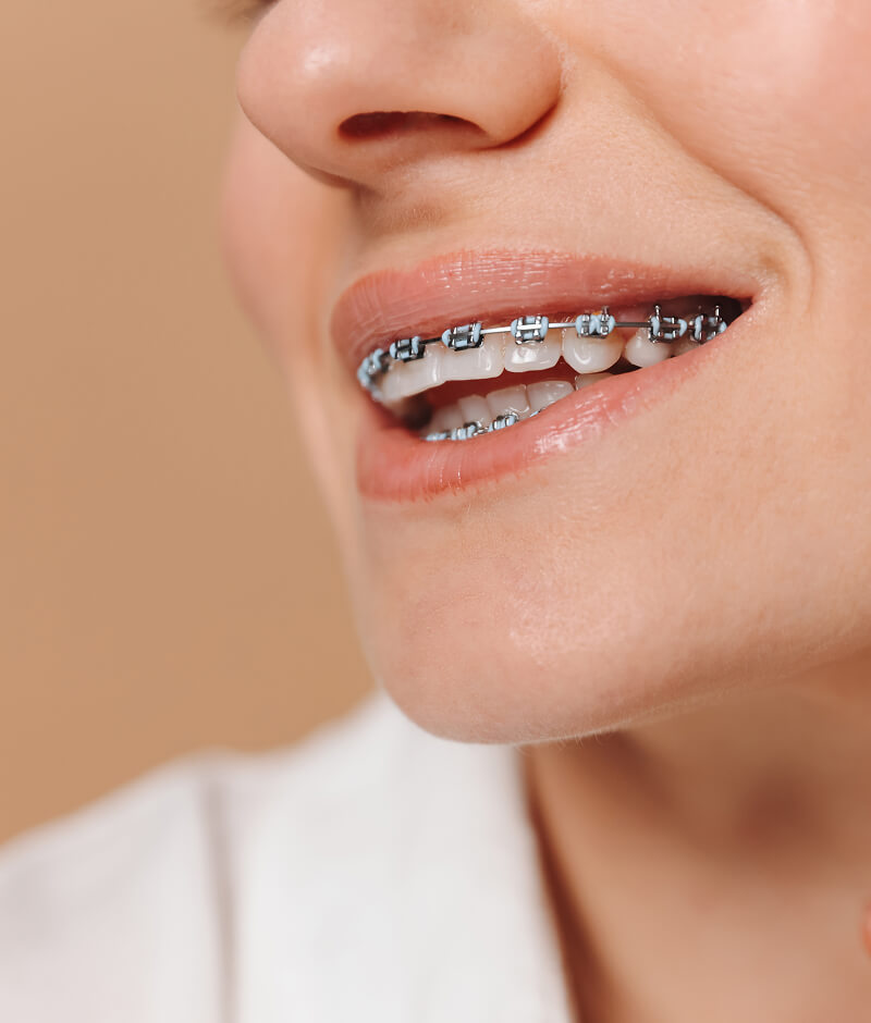 orthodontics Laguna Beach, CA