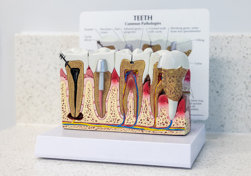 3D diagram showing different periodontal issues